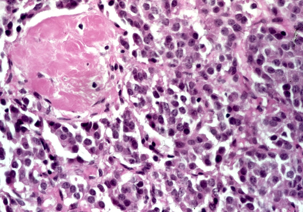 Pathology Outlines Medullary Carcinoma 